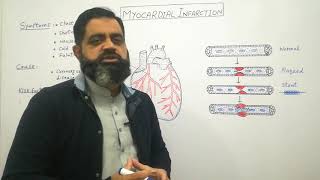 Myocardial infarction Urdu Hindi medium profmasoodfuzail Heart attack  Angioplasty [upl. by Claudell]