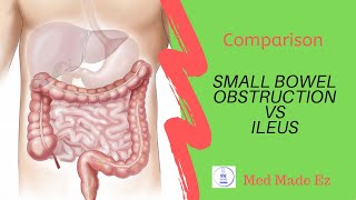 SBO vs Ileus  What is the difference [upl. by Ainoyek]