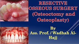 42Periodontal surgery11Resective osseous surgeryDr Wadhah Periodontology lecturesدوضاح الحاج [upl. by Rhpotsirhc189]