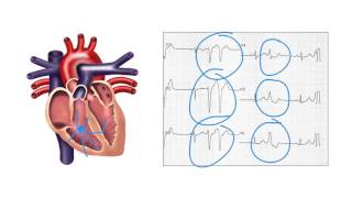 Determining the origin of ventricular ectopic beats on the ECG  Ask Andrew [upl. by Nairb366]