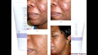 RodanFields UnBlemish Regimen Before and After Picture Album [upl. by Nirrad]