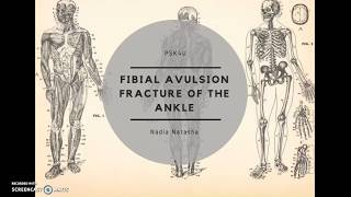 Fibular avulsion fracture of the ankle [upl. by Simmie]