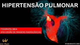 Hipertensão Pulmonar  Fisiopatologia e Discussão de Imagens Radiológicas [upl. by Nolram]