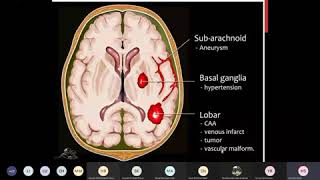 Pathology of cerebrovascular diseases  intraparenchymal heamorrhage1 [upl. by Attwood]