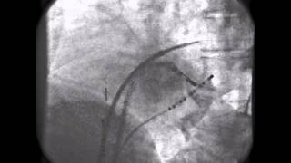 HandsOn Ablation  Video 1225 [upl. by Durrett]