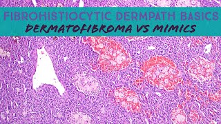 Fibrohistiocytic Dermpath Basics  dermatofibroma amp mimics dermatology dermatopathology pathology [upl. by Lilac977]