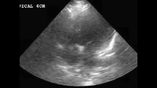 Dyspnea hx CHFCOPD whatsthedx [upl. by Ecinreb]