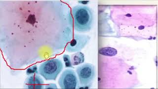 Aula citopatologia 8atipias e malignidades de células escamosas cervical [upl. by Ecyob]