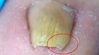 Large areas of onychomycosis trim ingrown nails【Crazy pedicure room】 [upl. by Hallie324]