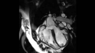 Cardiac MRI  Tetralogy of Fallot [upl. by Hareehahs]