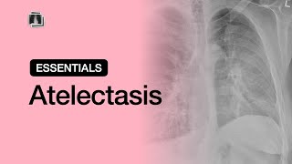 Atelectasis  Chest Radiology Essentials [upl. by Reldnahc979]