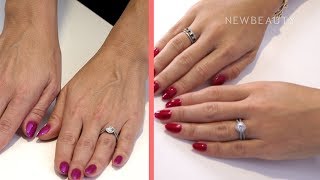 Hand Rejuvenation and Filler I Between the Before and After Ep 1  NewBeauty [upl. by Ellohcin]