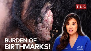 When a Birthmark Becomes a Burden  Dr Pimple Popper [upl. by Anhoj]