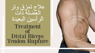 علاج تمزق وتر العضلة ذات الرأسين البعيدة  Treatment of distal biceps tendon rupture [upl. by Maritsa]