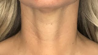 Scarless Thyroidectomy  Transoral Endoscopic Thyroidectomy Vestibular Approach [upl. by Chesna]