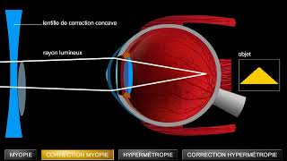 Troubles de la vision myopie et hypermétropie [upl. by Lettig]