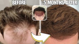 The SECRET To Early Hair Transplant Growth Dr Bisanga [upl. by Porta154]