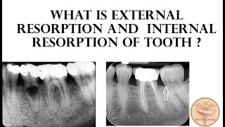 External Resorption and Internal Resorption of Tooth [upl. by Attenev16]