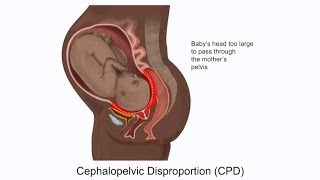 Cephalopelvic Disproportion CPD and Birth Injury [upl. by Nigam]