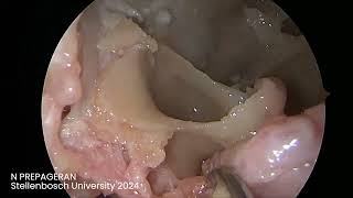 Module 8 Endoscopic approach to Foramen Rotundum Foramen Ovale Vidian Canal and Meckels Cave [upl. by Inar723]