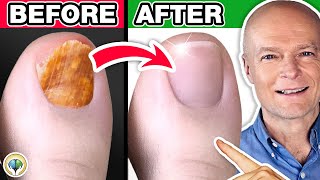 1 Absolute Best Toenail Fungus Cure [upl. by Mala]