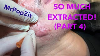 So much extracted Severe acne before and after Session 2 Comedones for days [upl. by Amabil314]