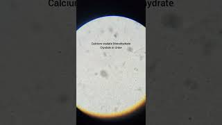 Calcium Oxalate Monohydrate Crystals in Urine Microscopicpathology [upl. by Carmena]