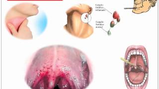 Streptococcus Pyogenes [upl. by Enner]