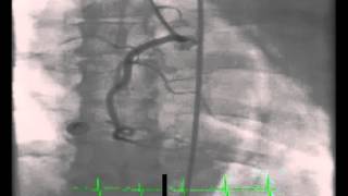 Right Coronary Artery Angiogram [upl. by Oos361]