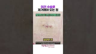 이건 수술로 제거해야 되는 점 부산피부섬유종 Dermatofibroma [upl. by Eidnak]