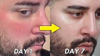 How I healed My Broken Skin Barrier In 7 Days [upl. by Malvin]