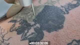 Revlite Tattoo Removal [upl. by Ahkeber]