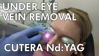 Under Eye Vein Removal Cutera NdYAG Laser  Dr Paul Ruff  West End Plastic Surgery [upl. by Jaella]