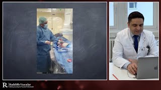 Treating calcified lesions using the Shockwave Lithoplasty® System  Prof K Donas [upl. by Lorenz]