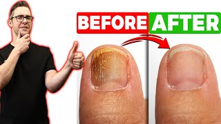 BEST Toenail Fungus Treatment 2024 4 BIG SECRETS [upl. by Aerdnac315]