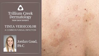 How to spot Tinea Versicolor a common fungal rash [upl. by Bernadene]