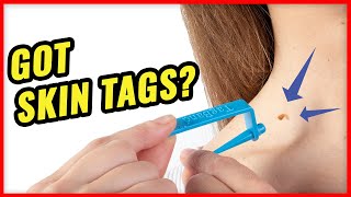 How to Remove Skin Tags Fast with TagBand [upl. by Ajiam5]