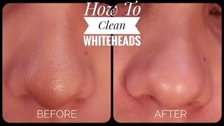 Nose Blackheads Whiteheads Removal  Face Acne Spa Treatment  Satisfying Nose Pimple Removal  155 [upl. by Aiset]