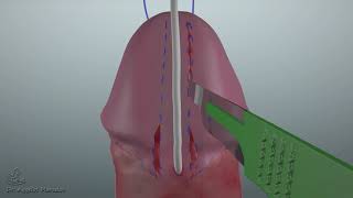 Distal Hypospadias Repair Animation [upl. by Siramaj]