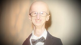 Sammy Basso Oldest Living Person With Progeria Dies at 28 [upl. by Johns845]