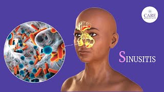 Sinusitis Explained by CARE Hospitals [upl. by Wylde]