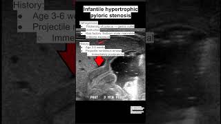 Infantile hypertrophic pyloric stenosis [upl. by Evelin]