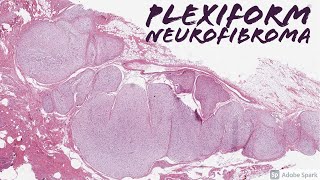 Plexiform Neurofibroma in Neurofibromatosis1 NF1 5Minute Pathology Pearls [upl. by Mendel461]