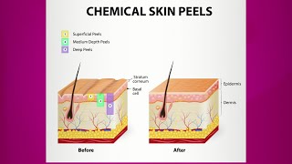 Chemical Peel Purpose amp Types [upl. by Zilvia]