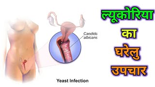 ल्यूकोरिया का घरेलु उपचार कैसे करे  Leukorrhea treatment in hindi  safed pani ka desi gharelu ilaj [upl. by Enelyaj]