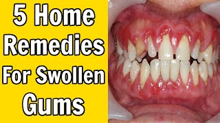 5 Home Remedies For Swollen Gums [upl. by Casi]