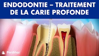 Endodontie  Traitement de la carie profonde © [upl. by Ardnoel20]