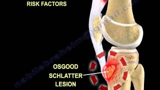 Osgood Schlatter Disease  Everything You Need To Know  Dr Nabil Ebraheim [upl. by Potter787]