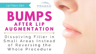 Bumps after Lip Augmentation  Dissolving Filler in a Small Focused Area [upl. by Aivizt475]