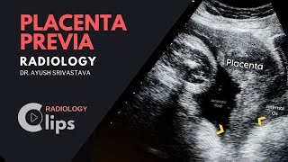 Placenta previa Everything you need to know  Obstetric Ultrasound  Radiology [upl. by Dwyer]